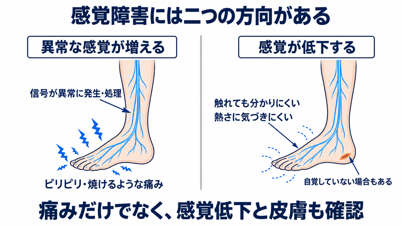 ニューロパチーとは？原因・症状・検査から看護観察と緊急性まで分かりやすく解説：感覚障害は「しびれる」だけでなく、痛みが増える症状と感覚を失う症状の両方があるの図解