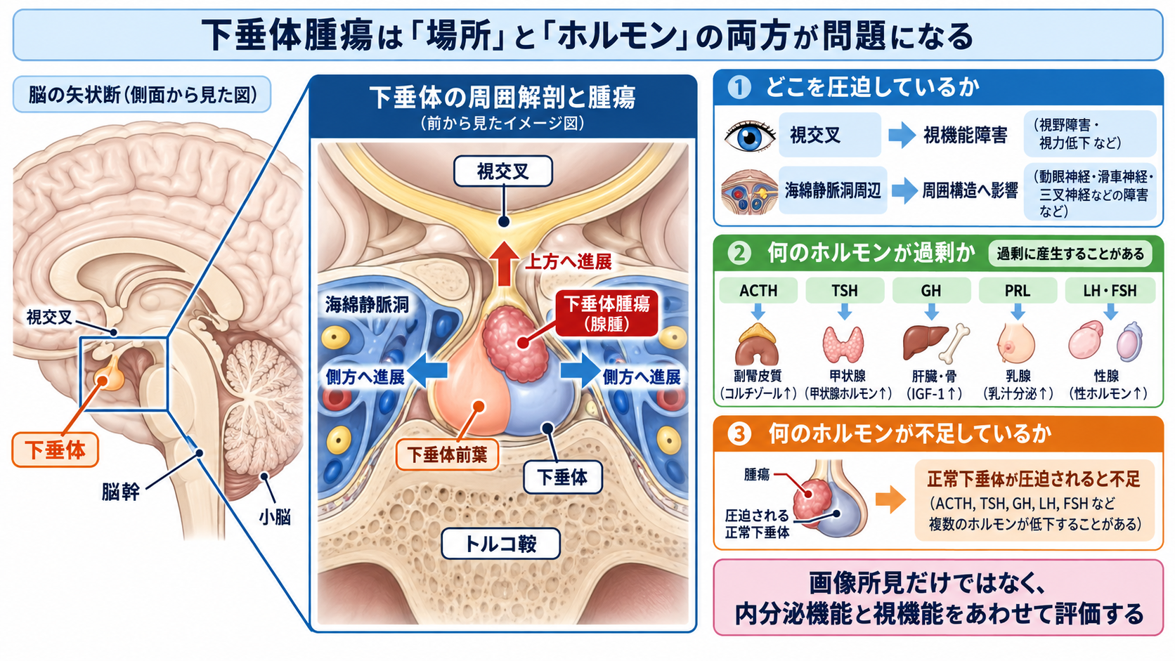 脳下垂体腫瘍とは？症状・ホルモン異常・治療と術後看護の観察ポイント：下垂体腫瘍は「場所」と「ホルモン」の両方が問題になるの図解