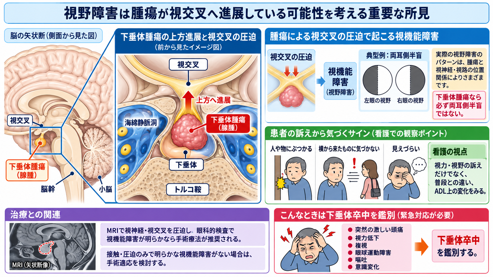 脳下垂体腫瘍とは？症状・ホルモン異常・治療と術後看護の観察ポイント：視野障害は腫瘍が視交叉へ進展している可能性を考える重要な所見の図解