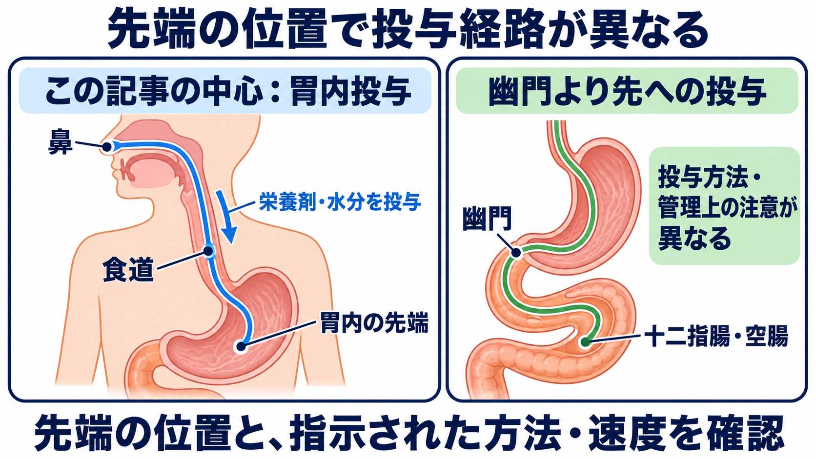 経鼻経管栄養の使い方｜体位の基本とチューブ位置確認、誤嚥・閉塞を防ぐ注意点：この記事で扱う「経鼻経管栄養」は、主に経鼻胃管から胃内へ投与する方法の図解